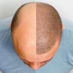 Best Hair Transplant Clinics in Lahore