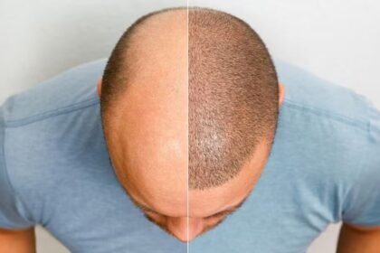 Best Hair Transplant Clinics in Lahore